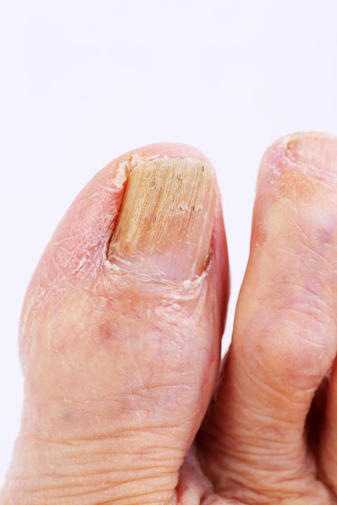 Hình ảnh một bàn chân có các ngón chân với móng màu vàng và nâu, trông dày và biến dạng.