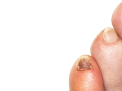 Hình ảnh một bàn chân với ngón chân cái có móng màu tím đậm do chấn thương.