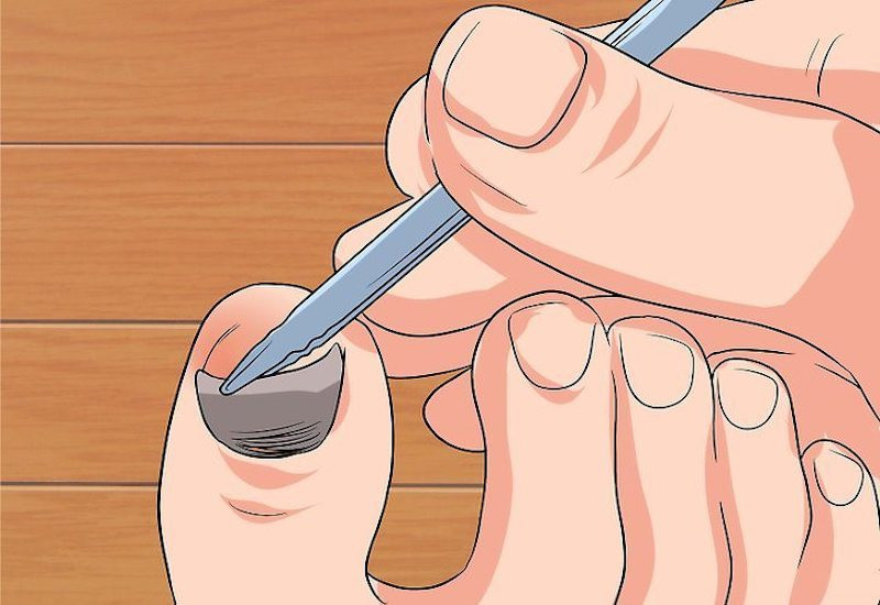 Hình ảnh một người đang kiểm tra ngón tay bị tổn thương móng, nhấn mạnh việc không nên tự ý rút móng để bảo vệ lớp gian bào.