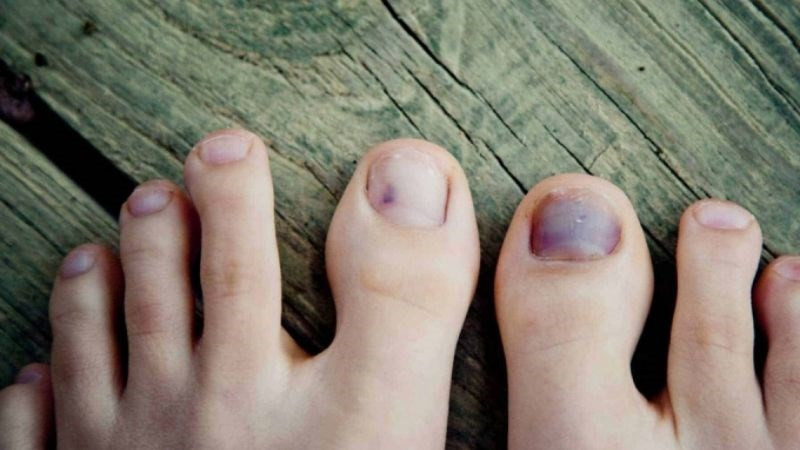 Hình ảnh một người đang mang giày chật gây áp lực lên móng chân cái bị hư