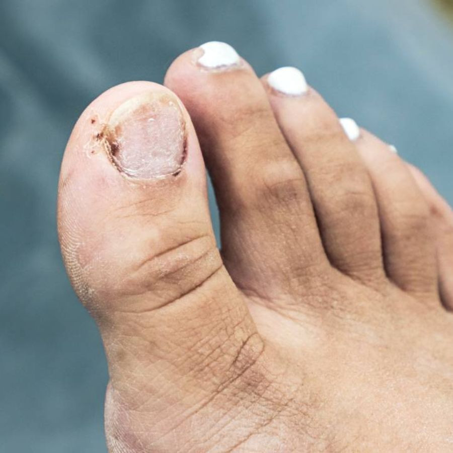Hình ảnh ngón chân để móng bị đen quá lâu sẽ dễ bị nhiễm trùng
