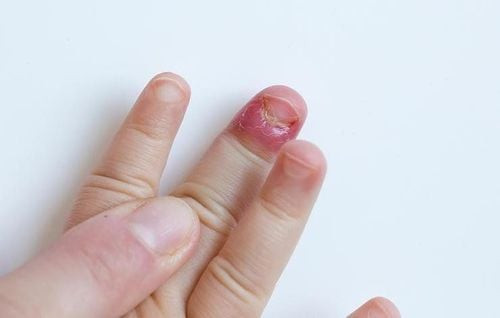 Hình ảnh ngón tay trẻ bị tổn thương do cắn móng tay liên tục, gây đau và chảy máu