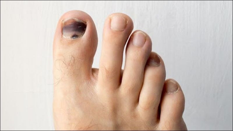 Hình ảnh người đang cắt tỉa móng chân cái bị bầm tím sau khi đã vệ sinh sạch