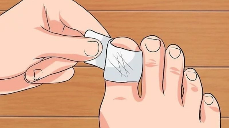 Hình ảnh người đang dùng băng gạc bảo vệ móng chân cái khỏi bụi bẩn và vi khuẩn