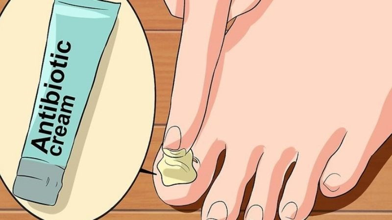Hình ảnh thoa thuốc mỡ kháng sinh lên móng chân cái để ngăn ngừa nhiễm trùng