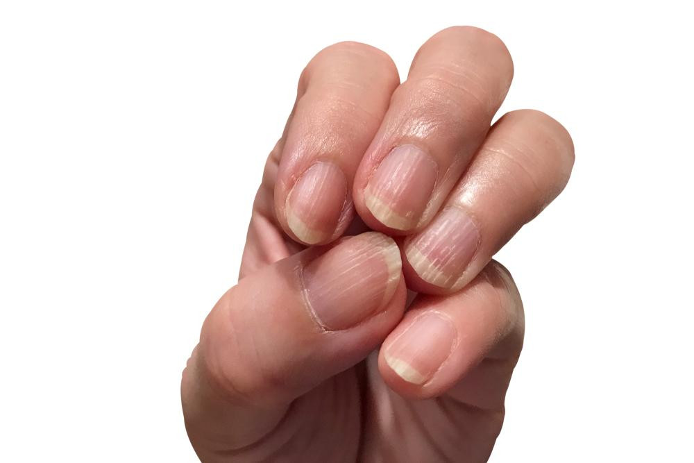 Hình ảnh tổng quan về các dạng sọc trên móng tay và dấu hiệu bệnh lý liên quan.