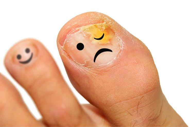 Hình ảnh tổng quan về tình trạng nấm móng chân và tác động của nó