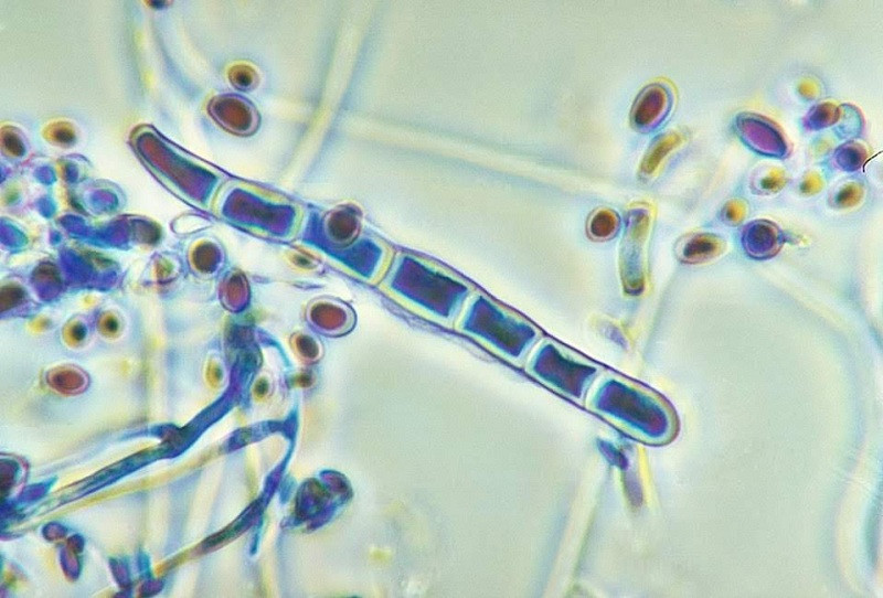 Hình ảnh vi nấm Trichophyton gây nhiễm trùng móng tay, móng chân