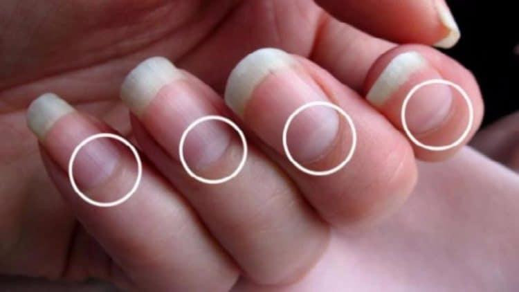 hình bán nguyệt lớn bất thường trên móng tay của người bình thường
