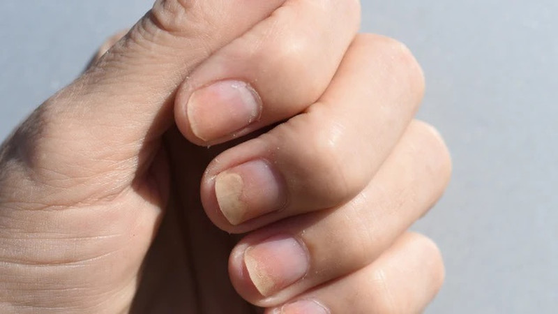 Hóa chất làm móng ảnh hưởng đến tình trạng móng tay bị thụt vào trong