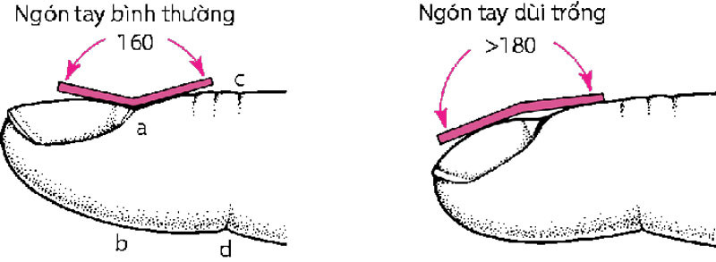 Hướng dẫn chẩn đoán móng tay dùi trống qua việc kiểm tra góc giường móng và dấu hiệu Schamroth, giúp nhận diện sớm biến đổi móng.