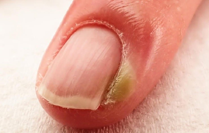 Khóe móng chân bị sưng mủ do viêm kẽ móng chân