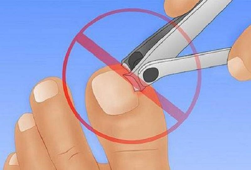 không được cắt móng chân khi móng chân có mủ