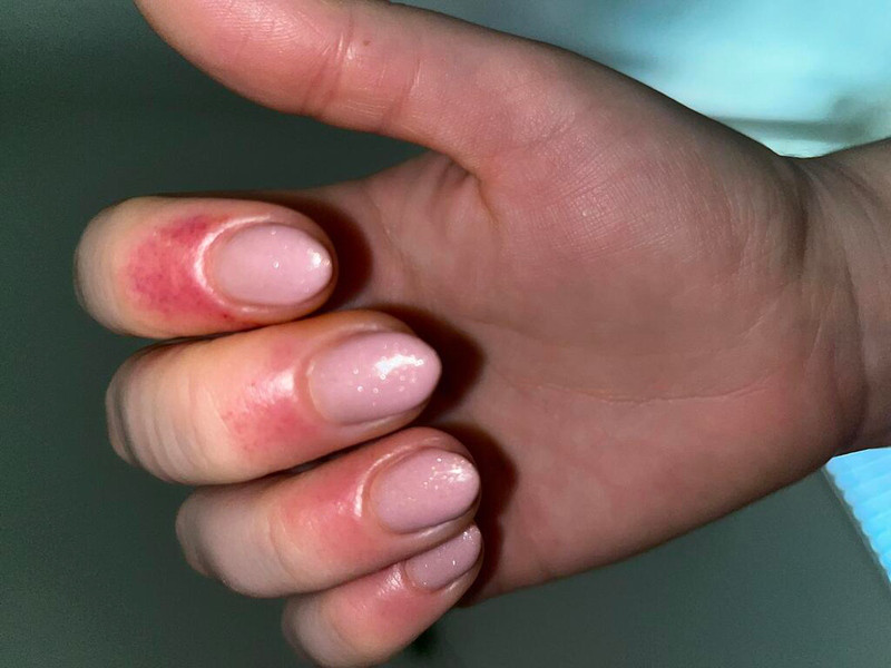 Kiểm tra dấu hiệu dị ứng hoặc kích ứng khi sử dụng sơn móng tay gel trong suốt.