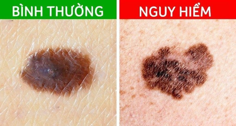 Kiểm tra màu sắc đa dạng của nốt ruồi ở móng tay
