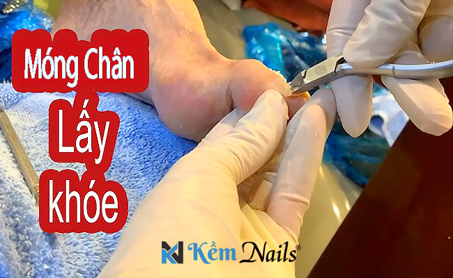 Lấy khóe móng chân bị sưng mủ cần đến cơ sở y tế