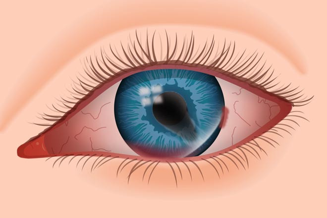 Mắt bị đỏ và chảy máu nhỏ dưới kết mạc do chấn thương.