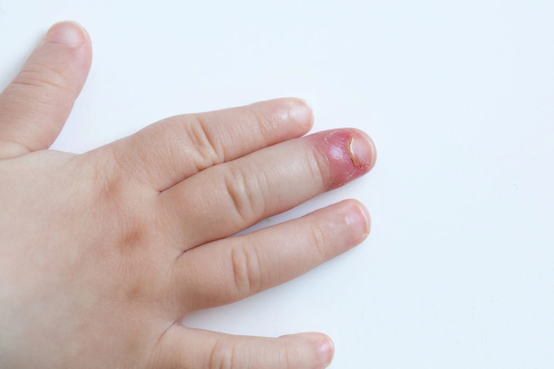 Minh họa các bệnh lý về da gây ra tình trạng xước da móng tay ở trẻ