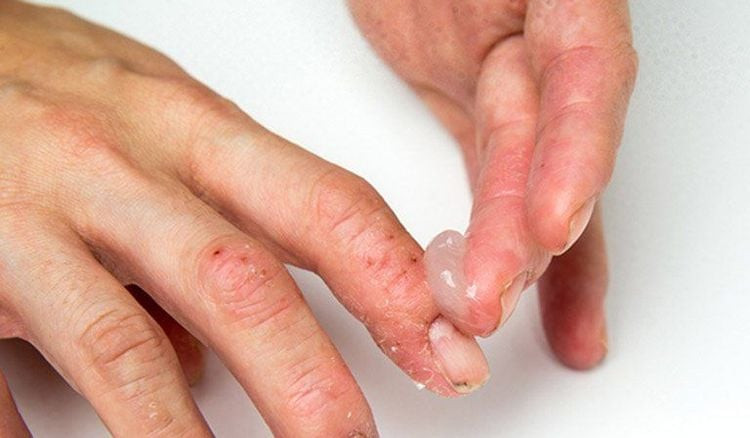 Minh họa việc thoa kem dưỡng ẩm giúp làm dịu và phục hồi da khi bị tróc da đầu móng tay