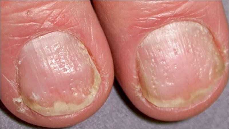 Móng chân bị ảnh hưởng bởi bệnh vẩy nến, xuất hiện các vết lõm và bong tróc
