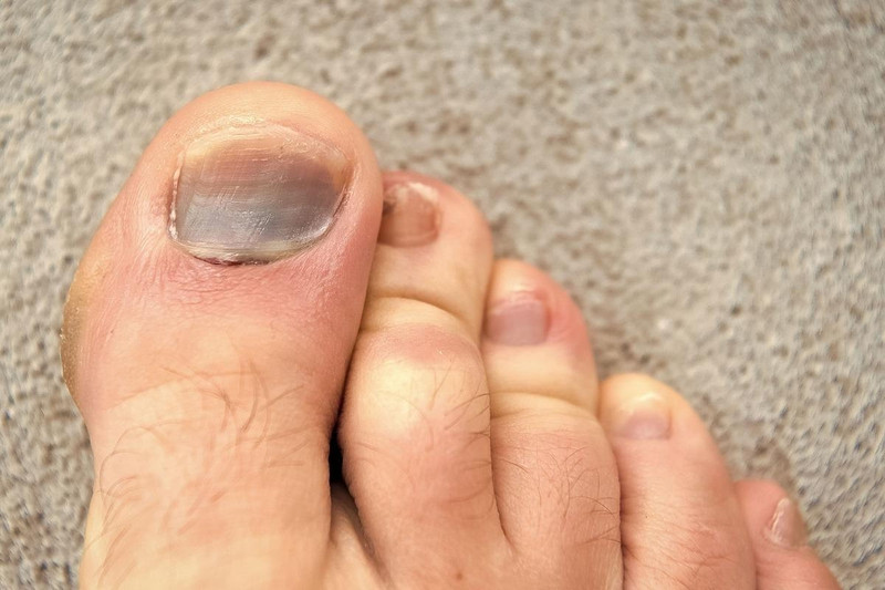 Móng chân bị bầm tím do chấn thương vật lý