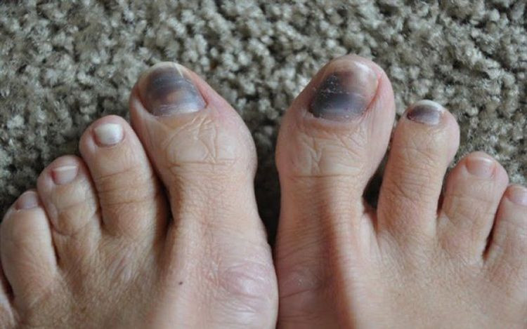 Móng chân bị dày lên kèm chảy máu, mủ do nhiễm trùng nặng