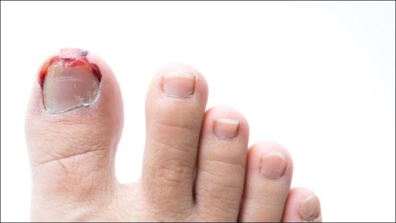 Móng chân bị hỏng nặng cần gặp bác sĩ