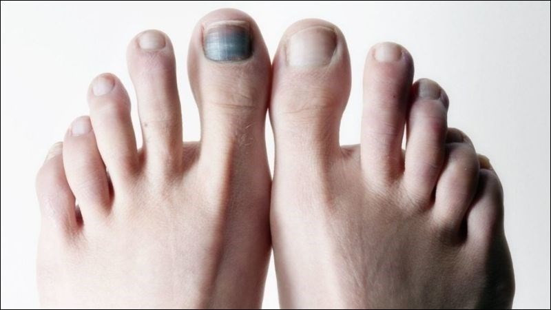 Móng chân bị hư có mọc lại được trong khoảng thời gian 18 tháng