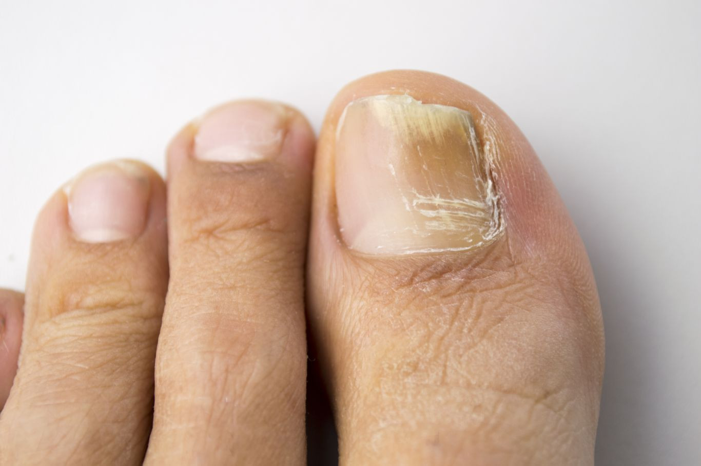 Móng chân bị nhiễm nấm với mảng màu trắng đục ở cạnh bên