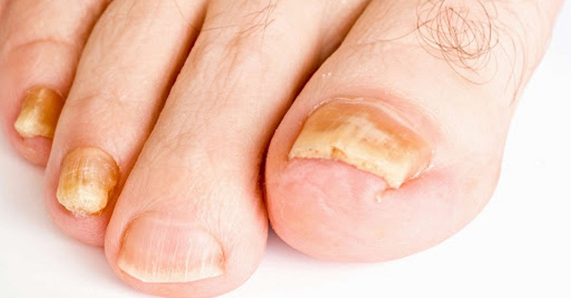 Móng chân bị nứt gãy, đổi màu vàng đục do nhiễm nấm