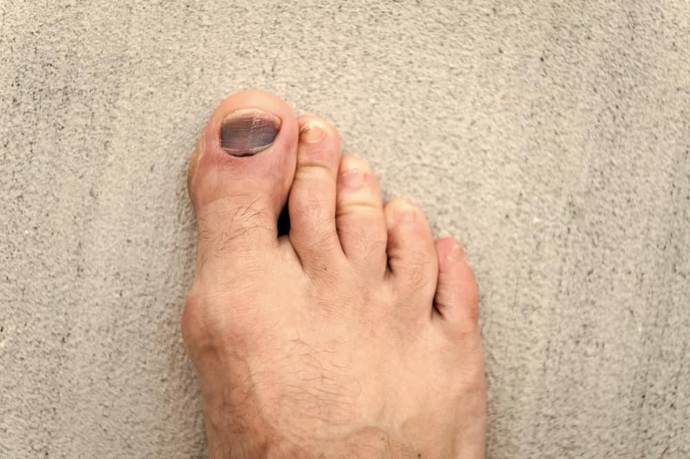 Móng chân bị tím do tụ máu bầm dưới móng sau chấn thương