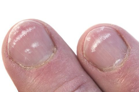 Móng chân có đốm trắng hoặc chuyển màu trắng do thiếu chất