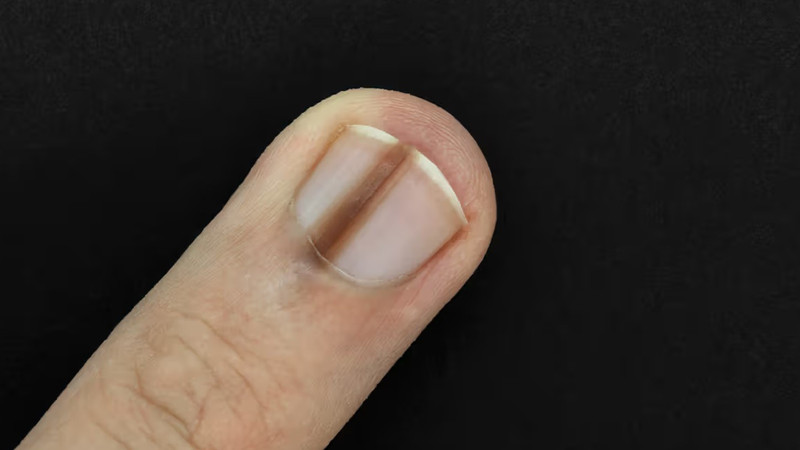Móng chân có vạch đen với nhiều nguyên nhân khác nhau cần được chú ý.