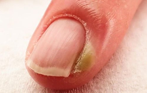 Móng chân sưng đỏ đau nhức do chín mé móng chân