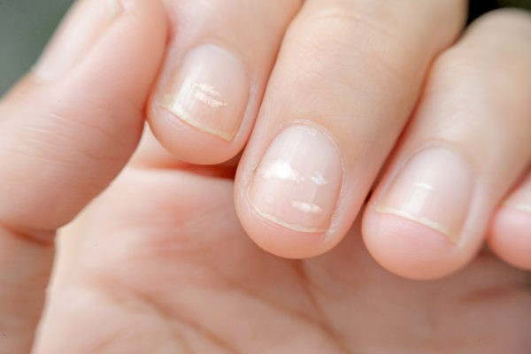 Móng chân út nứt theo chiều ngang do thiếu chăm sóc