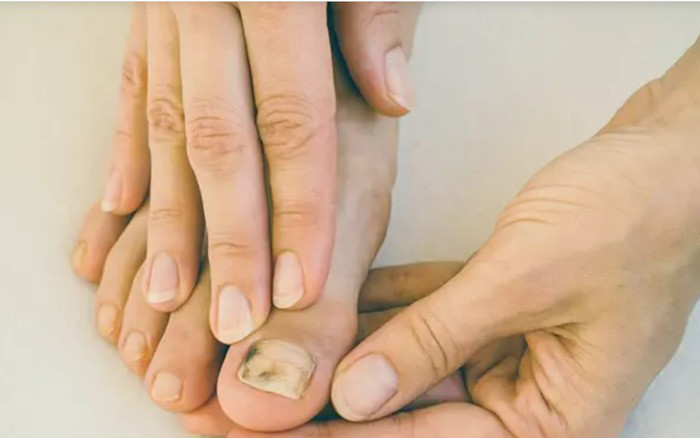Móng chân với sọc nâu đậm, nghi ngờ u hắc tố