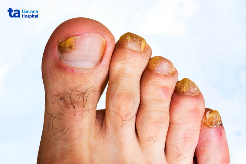 Móng ngón chân bị nấm và các biến dạng thường gặp