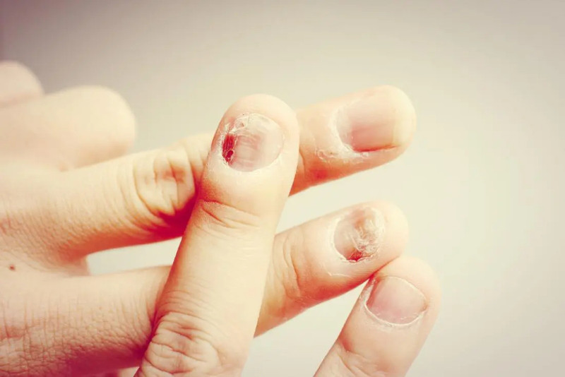 Móng tay bị dập cần được sơ cứu đúng cách