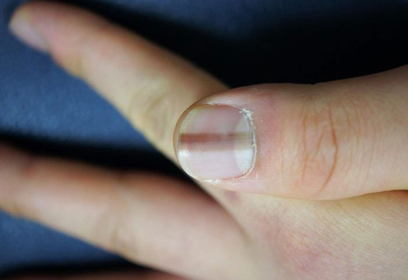 Móng tay bị đen có sọc nâu đen cảnh báo vấn đề sức khỏe nghiêm trọng