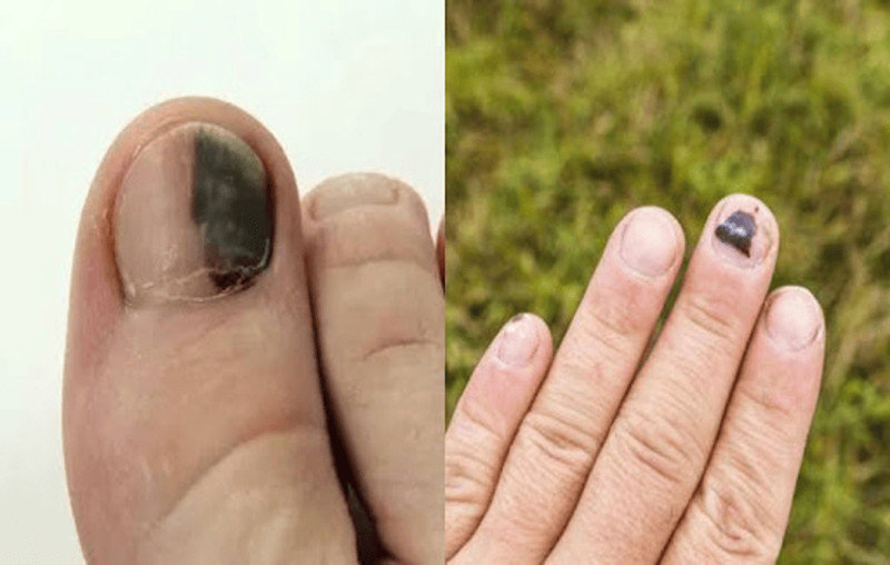 Móng tay bị đen có thể là dấu hiệu cảnh báo bệnh lý tiềm ẩn
