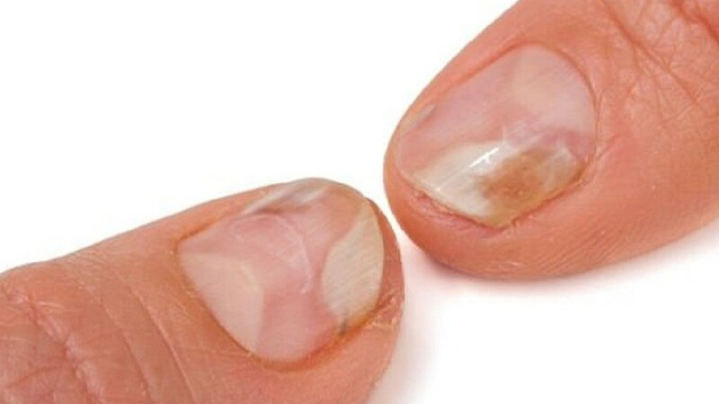 Móng tay bị hư do vi nấm gây ra
