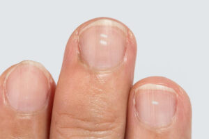 Móng tay bị hư tổn với các dấu hiệu như giòn, gãy, sứt mẻ cần được bổ sung dinh dưỡng để cứng khỏe