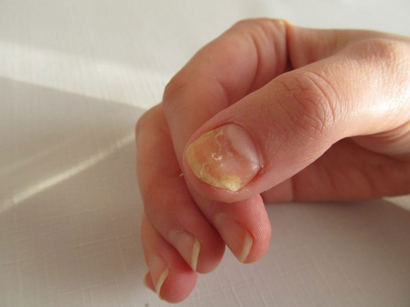 Móng tay bị lõm vào do chấn thương hoặc tiếp xúc hóa chất