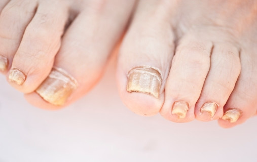 Móng tay bị nấm với các đốm trắng đục và sần sùi