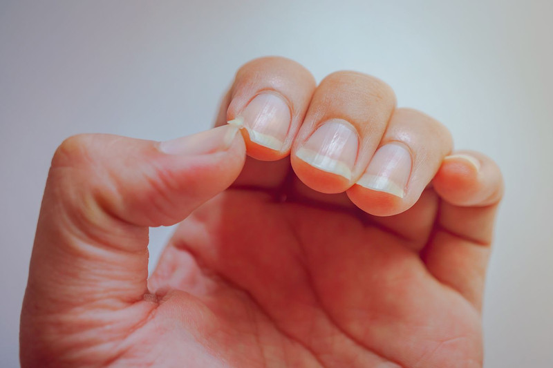 Móng tay bị sần gợn sóng thường trở nên yếu, giòn, dễ gãy hơn