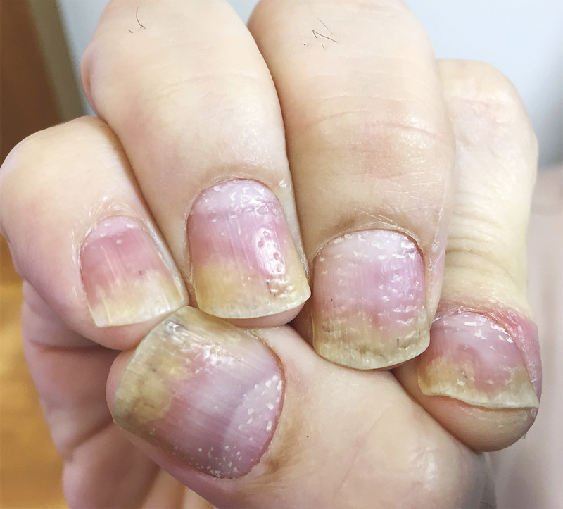 Móng tay bị sần sùi do bệnh nấm hoặc thiếu chất dinh dưỡng
