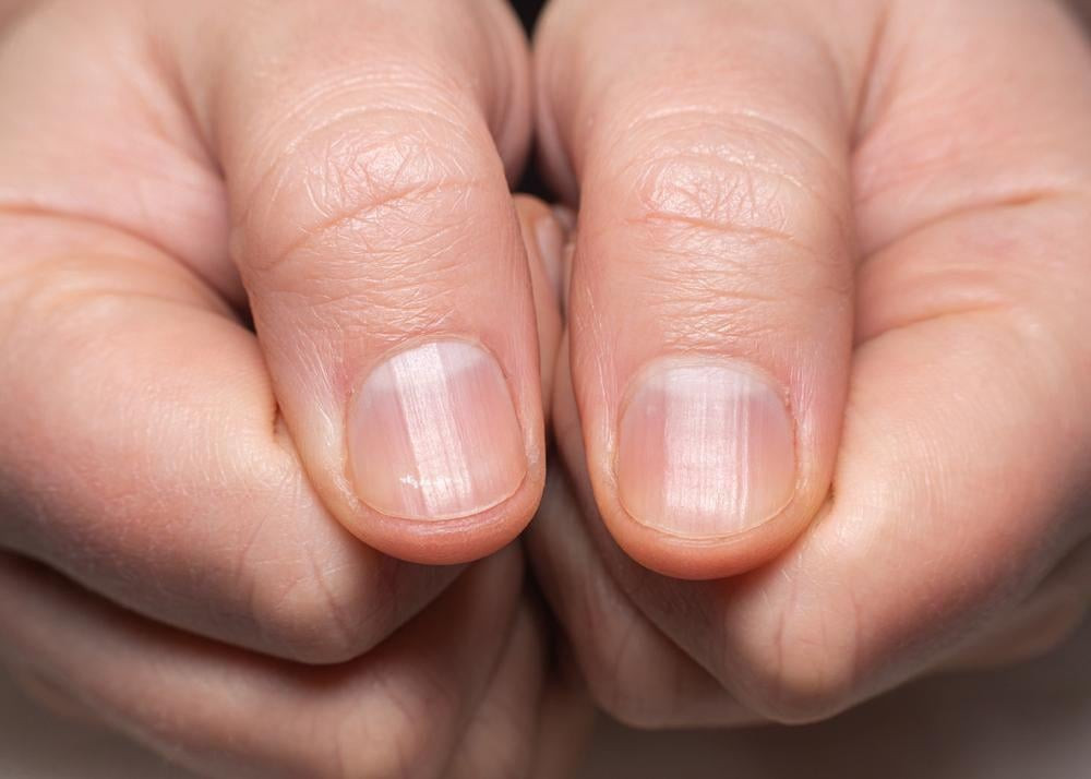Móng tay bị sọc dọc trắng mờ, thường liên quan đến thiếu vitamin hoặc chấn thương nhẹ.