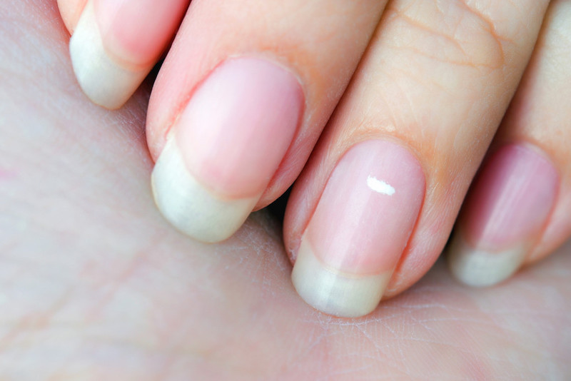 Móng tay bị tổn thương vật lý gây ra đốm trắng như hạt gạo