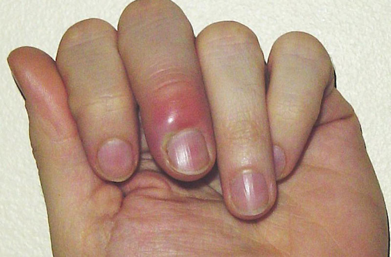 Móng tay bị viêm, sưng đỏ do cắt quá sát, minh họa nguy cơ nhiễm trùng và đau nhức.