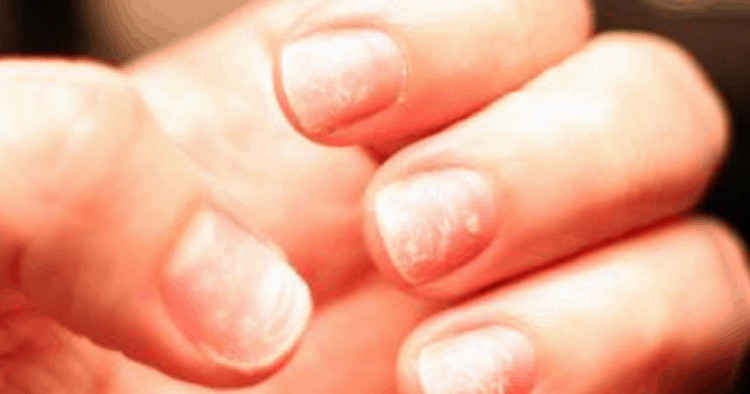 Móng tay bong tróc, sần sùi là biểu hiện của móng tay mắc bệnh vẩy nến